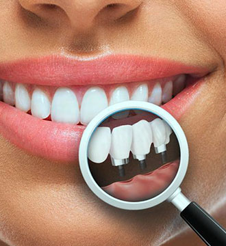 implantologie Dentară