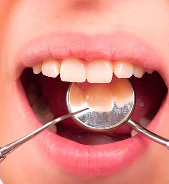 Obturație Dentară