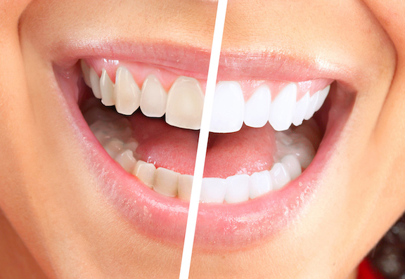 profilaxie Dentară